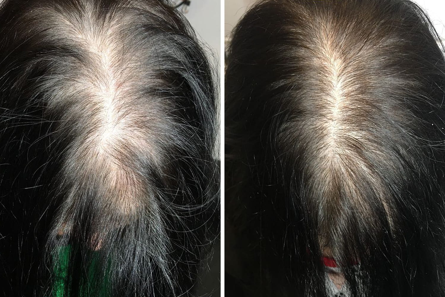 Mederi-Aesthetics-Procell-Hair-Rejuvenation-Example