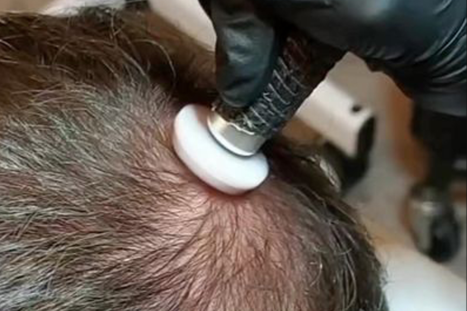 Mederi-Aesthetics-Procell-Hair-Rejuvenation