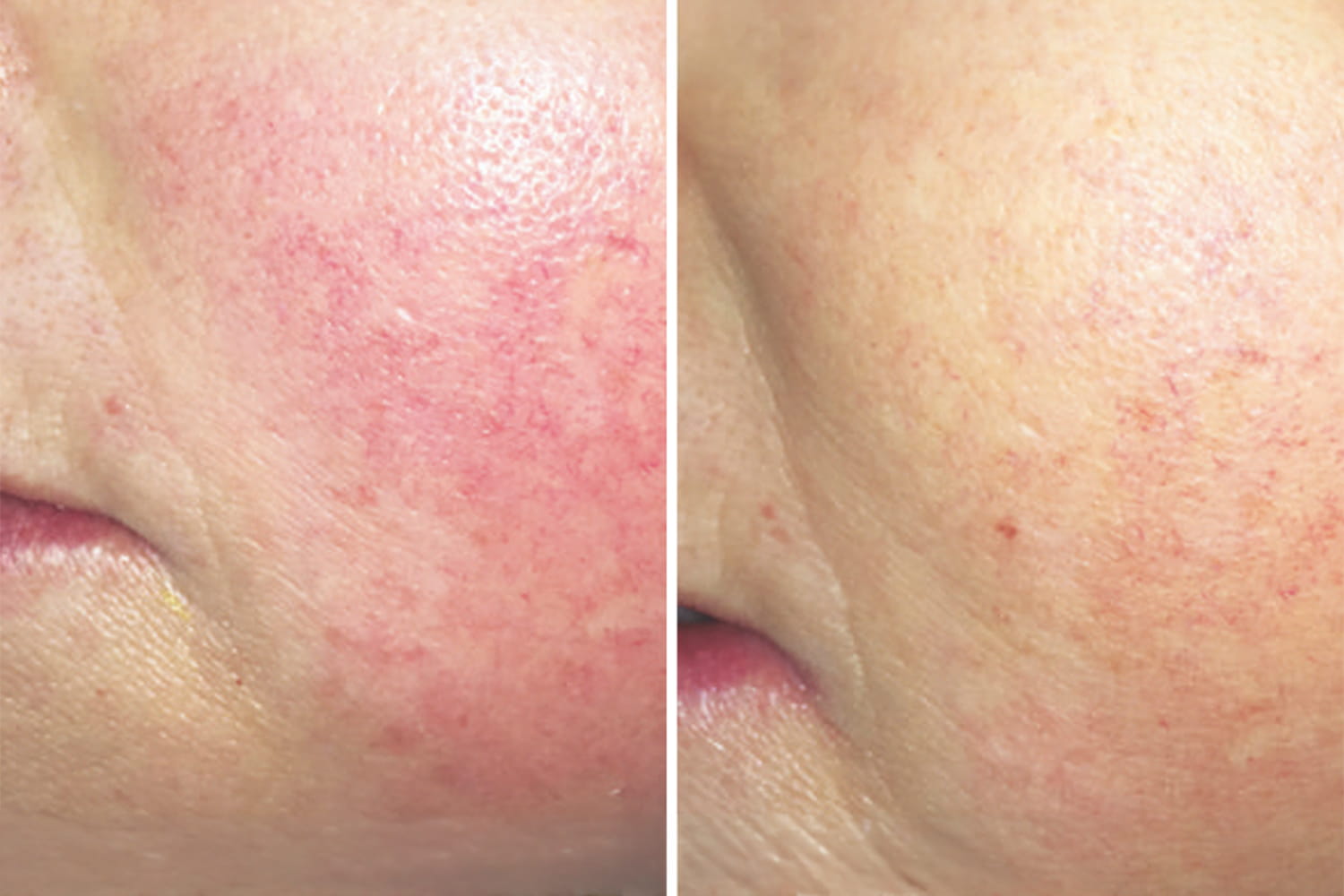 Mederi-Skin-Aesthetics-Procell-Skin-Rejuvenation-Rosacea