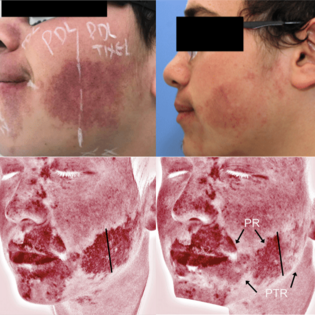 Mederi-Aesthetics-Tixel-Skin-Rejuvenation-2