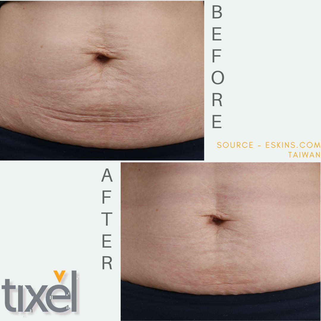 Mederi-Aesthetics-Tixel-Skin-Rejuvenation-Stretch-marks