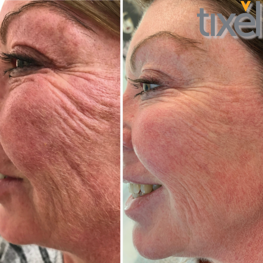 Mederi-Aesthetics-Tixel-Skin-Rejuvenation